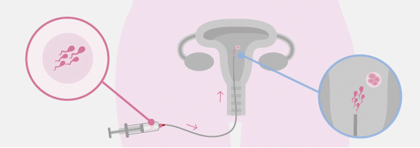 Inseminación artificial