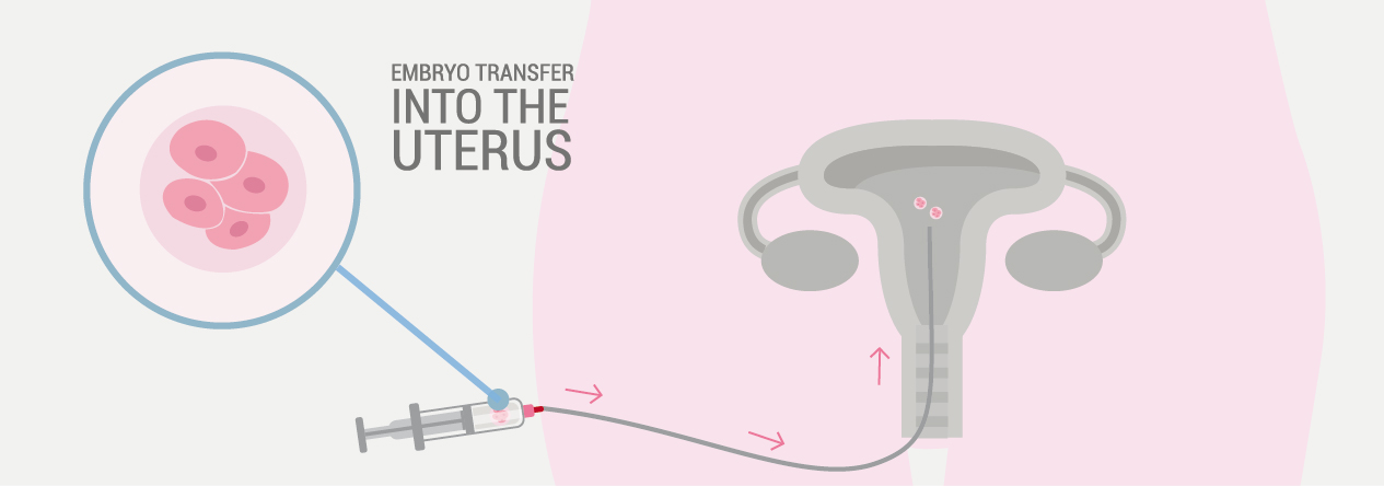 4 embryo transfer