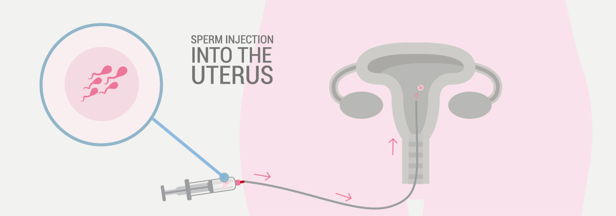 sperm injection into the uterus